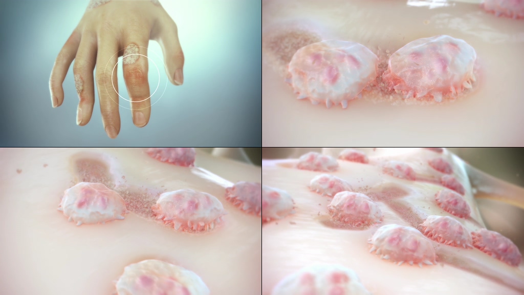 皮肤病细菌感染视频素材