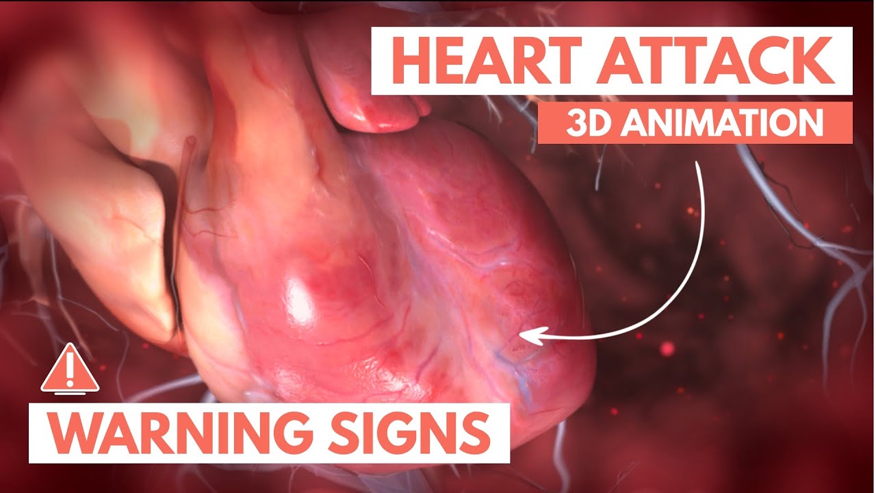 心脏病发作视频素材_医疗3D动画视频素材下载
