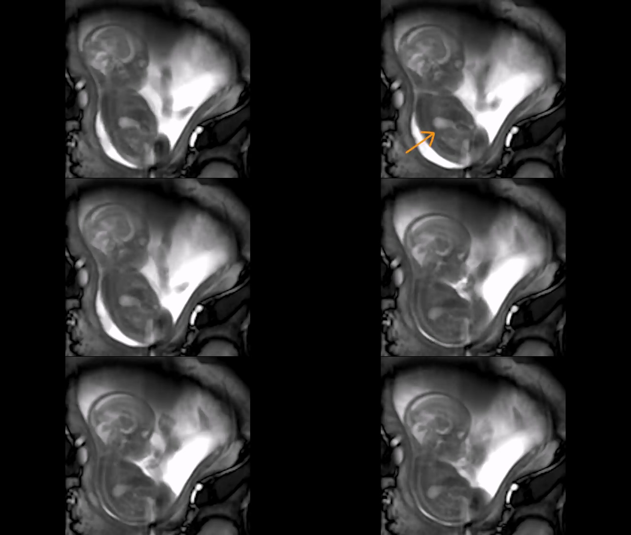 21周大的宝宝MRI扫描超声波胎动视频素材
