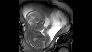 21周大的宝宝MRI扫描超声波胎动视频素材